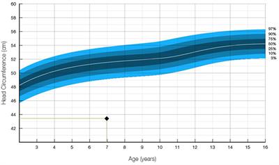 Two Novel Mutations (c.883-4_890del and c.1684C>G) of WDR62 Gene Associated With Autosomal Recessive Primary Microcephaly: A Case Report